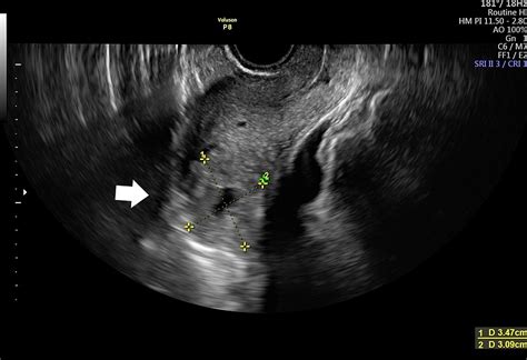 Cureus Interstitial Pregnancy Case Report Of Atypical Ectopic Pregnancy Hot Sex Picture
