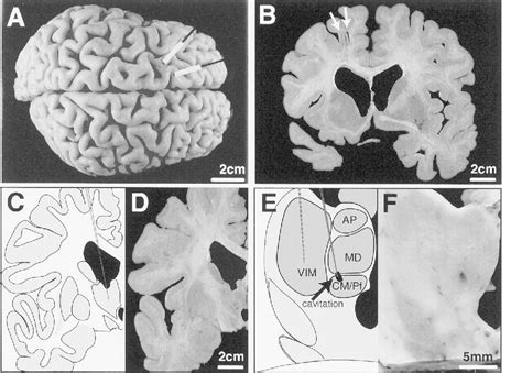 Figure 1 From Lesion Of Thalamic Centromedian Parafascicular Complex