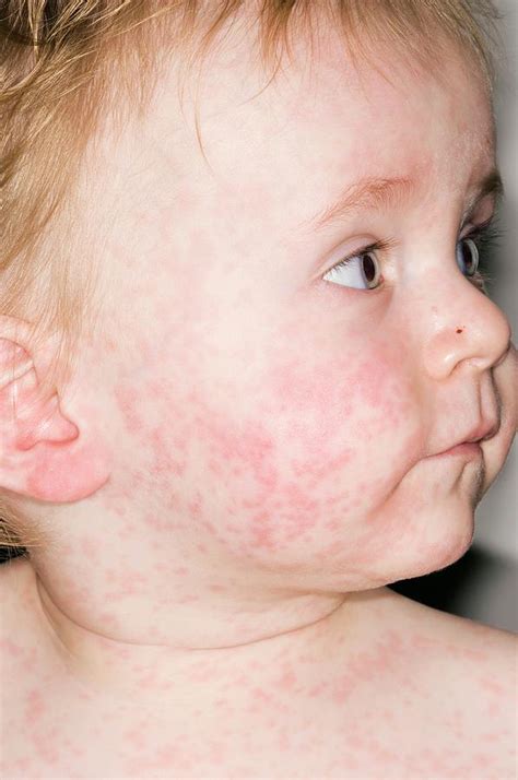 Top 20 Childrens Rashes And Baby Skin Conditions Common Baby Skin