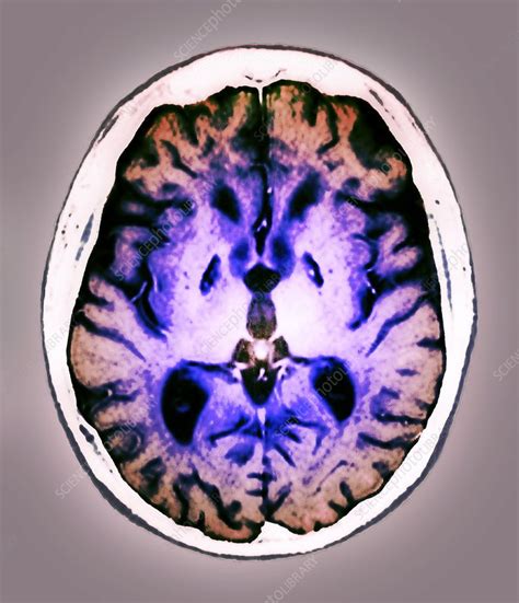 Anoxia Brain Damage Mri Scan Stock Image C0041467 Science Photo