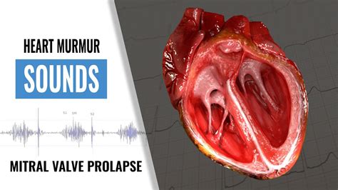 Mitral Valve Prolapse Heart Sound Heart Sounds Heart Murmur Mvp