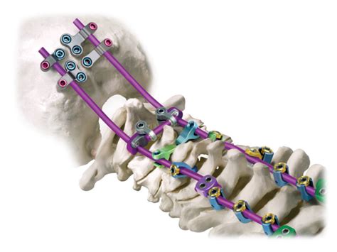 Posterior Cervical Globus Medical