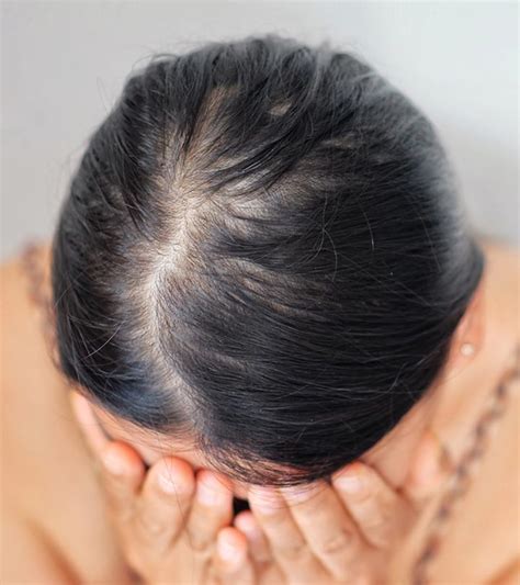 Diffuse Hair Loss Alopecia Causes Signs And Treatments