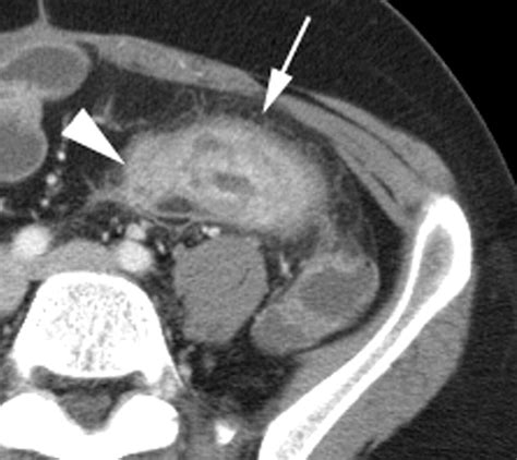 Ct Enterography As A Diagnostic Tool In Evaluating Small Bowel