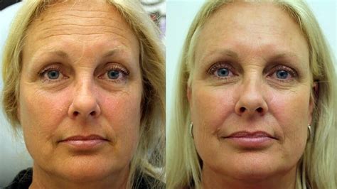 Botox Treatment Utah County Utah Valley Dermatology