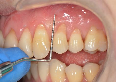 Povlačenje Zubnog Mesa Recesija Desni Dental Centar Mostarac