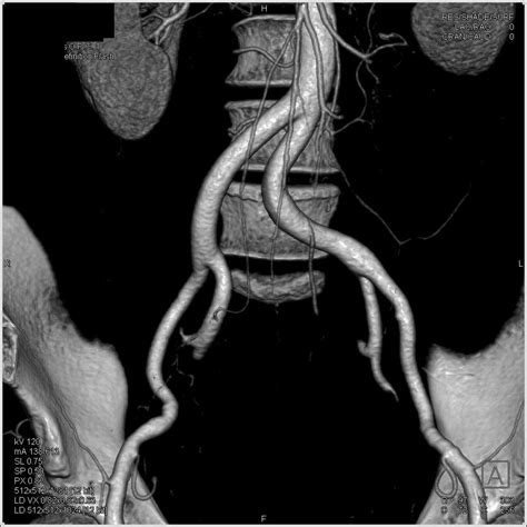 Fibromuscular Dysplasia Right Renal Artery Fmd Vascular Case