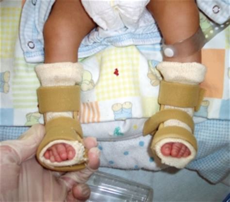With early treatment, the condition known as clubfoot can be corrected, and your child will be able to walk and run with the best of them. Society Spotlight Managing Orthotic Treatment in the NICU ...