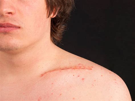 Scars From Shoulder Surgery Stock Photos Pictures And Royalty Free