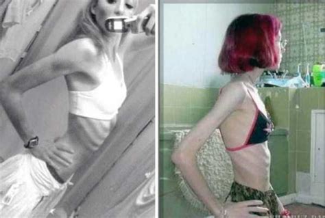 30 Shocking Pics Of Anorexic Girls KLYKER