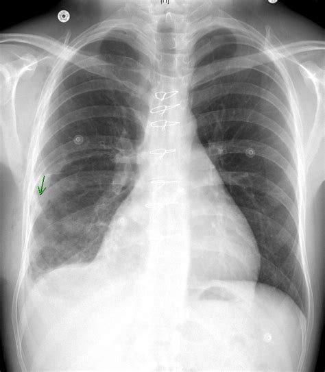 The Chest X Ray In Cardiovascular Disease Wikidoc
