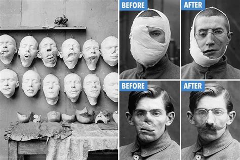 Incredible 100 Year Old Photos Reveal How Injured Ww1 Soldiers Were Given Masks To Help Cover