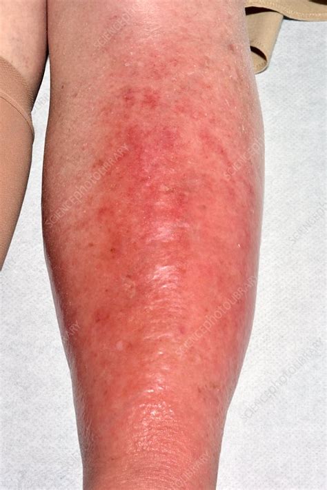 Hochement Rapport Beaucoup Cellulitis Legs Pictures Pionnier D Labr