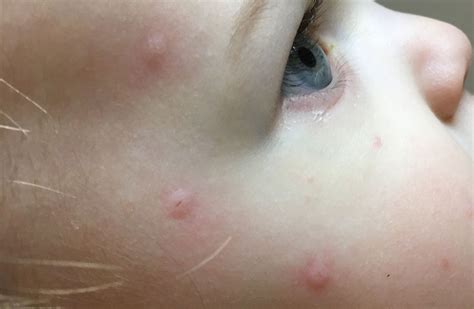 Bed Bug Bites On Babies Pictures Photos Images And Photos Finder