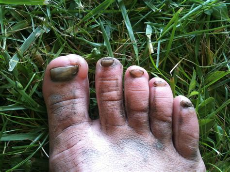 Losing Toenails | Dirt in Your Skirt – Explore. Conquer. Inspire.