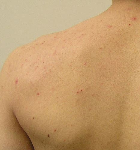 How To Get Rid Of Back Acne Fast