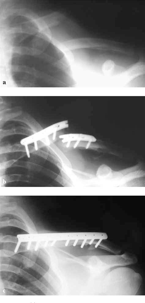 Figure 1 From Acute Management Of Clavicle Fractures A Long Term