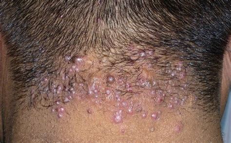 Movable Lump On Back Of Childs Head Manikee