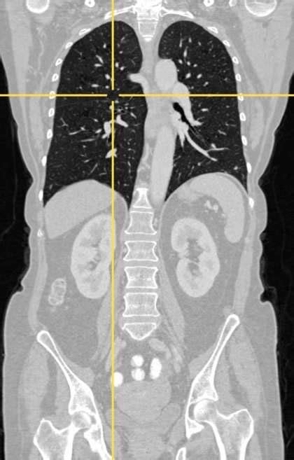 1 Registration Of Two Three Dimensional Follow Up Thorax Abdomen Ct