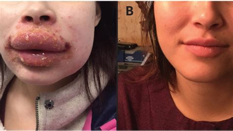 Polysporin Allergy Caused Womans Swollen Blistered Lips Doctors