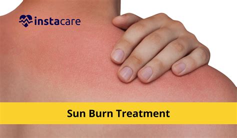 7 Effective Sunburn Treatment Options