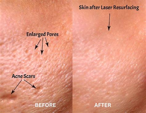 Best Scar Open Pores Removal Treatment At Twacha Aesthetic Skin