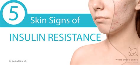 5 Skin Signs Of Insulin Resistance White Lotus Clinic