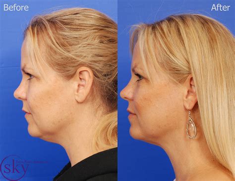 Kybella In San Diego Non Surgical Double Chin Reduction — Sky Facial