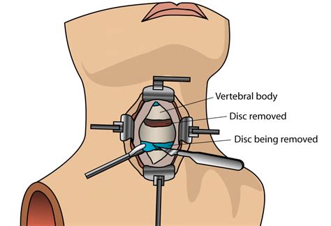 Anterior Cervical Discectomy And Fusion Acdf Surgery Cost India