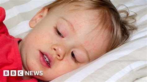Scarlet Fever Cases Hit 50 Year High In England