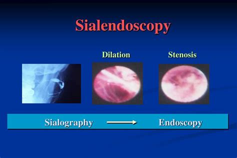 Ppt Chronic Obstructive Sialadenitis And Sialendoscopy Powerpoint