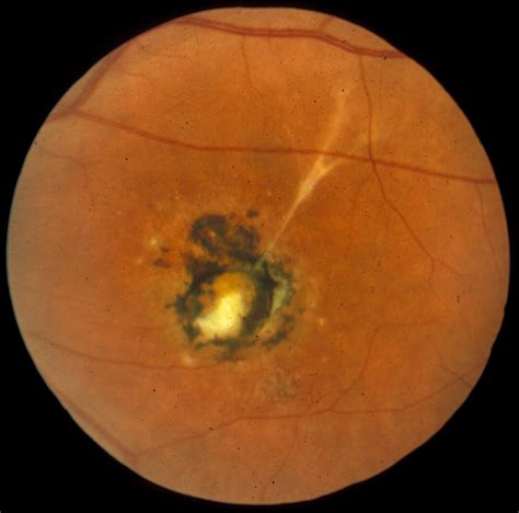 Macular Dystrophy Vitelliform 2 Hereditary Ocular Diseases