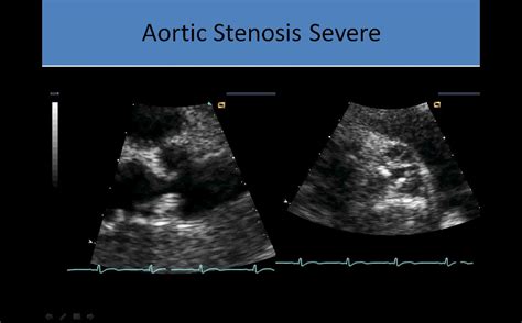 Stenosis Bicuspid Aortic Valve Stenosis