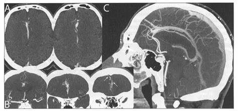 Figured tomography angiogram (CTA) can assist with lessening cardiovascular failures