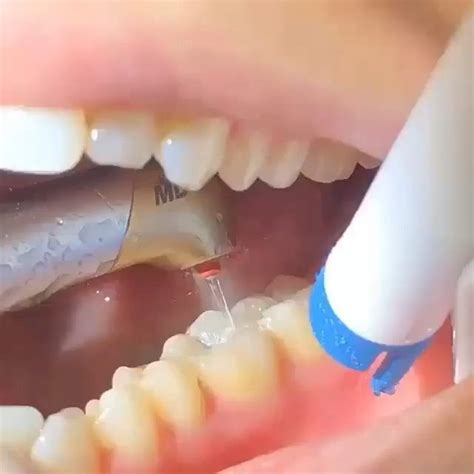 Cavity Preparation With A Dental Water Laser Dental Reviews Dental