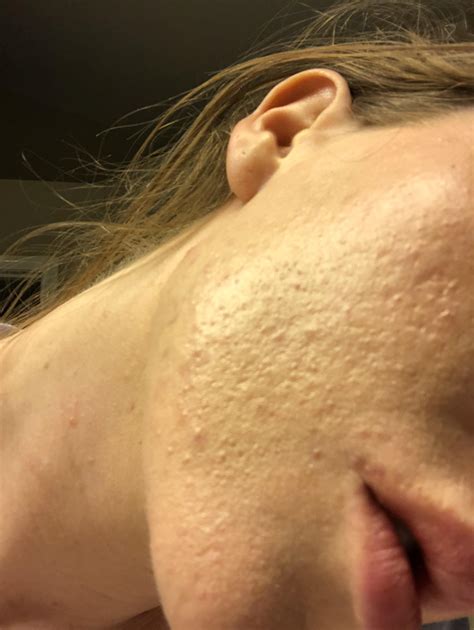 Skin Concern Please Anybody Does This Look Like Fungal Acne To You