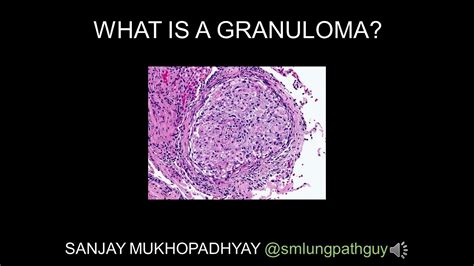 What Is A Granuloma Slideshare