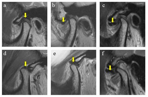 Jcm Free Full Text Craniofacial Morphology Of Temporomandibular
