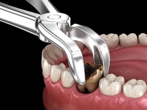 Tips To Prevent Dry Socket After Tooth Extraction