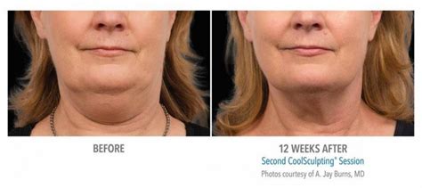 Coolsculpting Double Chin The Cosmetic Vein And Laser Center
