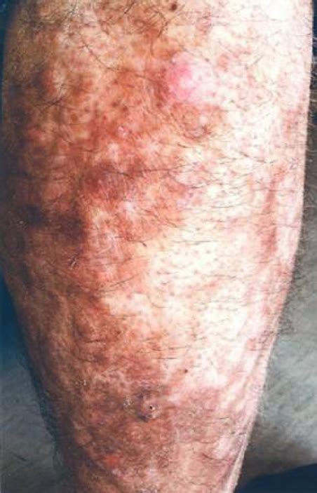 Rheumatoid Nodules Thickening Of Both Legs Skin With Multiple Nodules