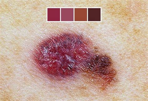 Moles & Melanoma Guide to Changes, Colors, Size & More — Scary Symptoms