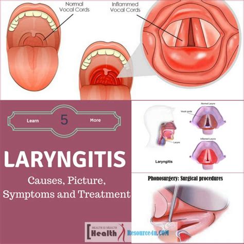 laryngitis causes picture symptoms and treatment