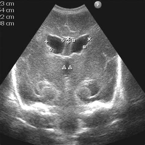 Management Of Posthaemorrhagic Ventricular Dilatation Adc Fetal