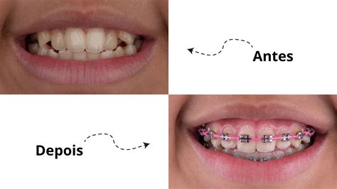 Veja Quais As Diferenças Dos Dentes Tortos Antes E Depois