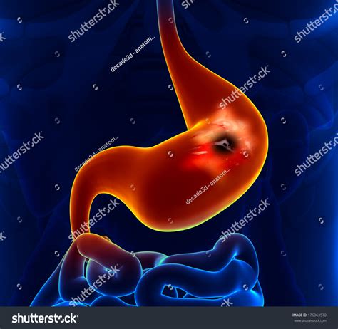 Stomach Cancer Stock Illustration 176963570 Shutterstock
