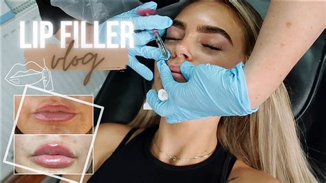 come with me to get lip filler vlog my lip filler experience youtube