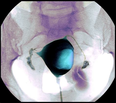 Uterine Fibroid X Ray Photograph By Du Cane Medical Imaging Ltd Fine