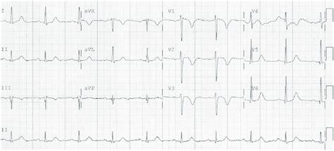 Twelve Lead Electrocardiogram Showed Sinus Bradycardia With A Rate Of