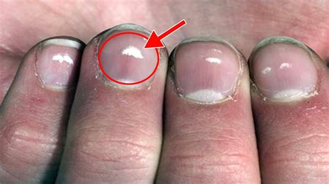 What Causes White Spots On Nails My Grandmother Told This Secret What